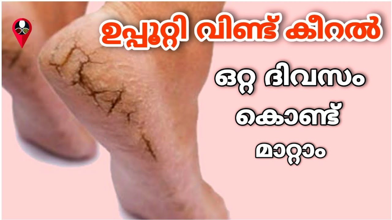 കാലിനി ഉരച്ചു കഷ്ട്ടപെടണ്ട| കാലിലെ വലിയ പ്രശ്നം സെക്കന്റ്‌ കൊണ്ട് മാറ്റാം| cracked heels home remedy