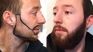 Beard Transplant Before and After - Month by Month Results | Elithair #7