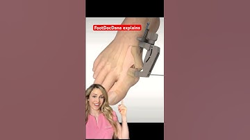 Minimally invasive bunion surgery animation