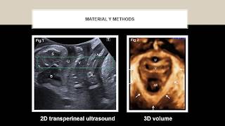 2D-3D Transperineal Ultrasound for the evaluation of patients with symptoms of posterior pelvic...
