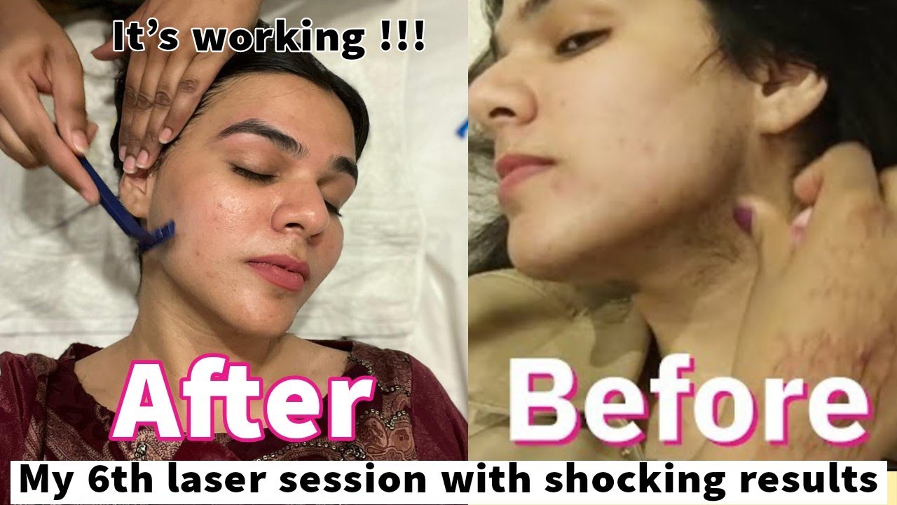 My 6th laser session review Honestly shocking results YouTube