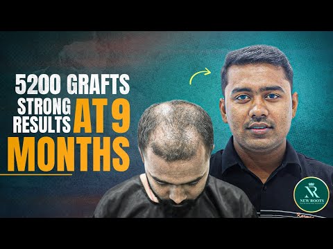 He Regained His Natural Hairline! 🙂 | Hair Transplant in Bangalore | New Roots