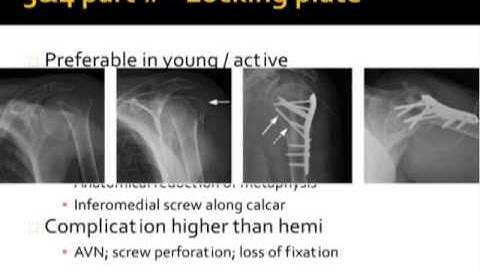 Proximal Humerus Fractures by Dr James Churchill