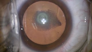Posterior Polar Cataract Surgery and More...