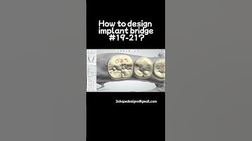 3shape design implant bridge #19-21