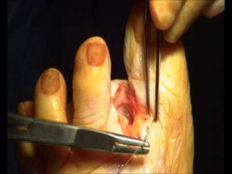 Toe Amputation