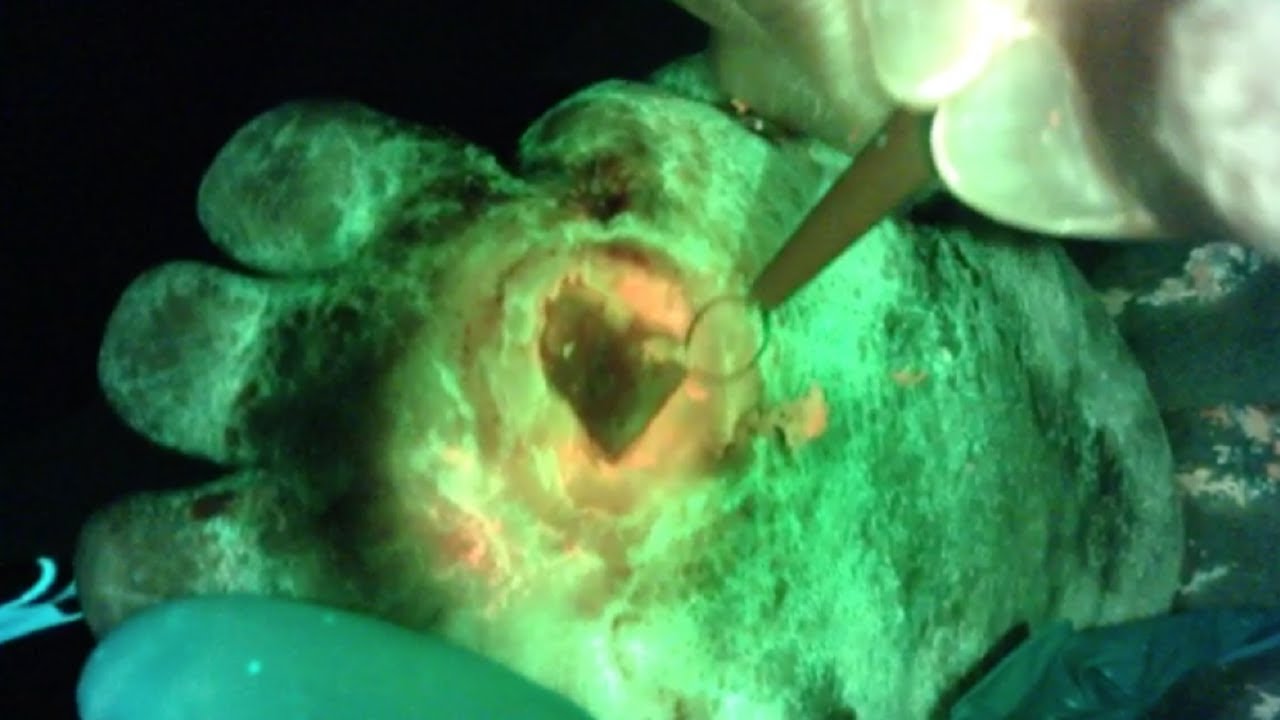 MolecuLight i:X Guides Wound Debridement of a Diabetic Foot Ulcer