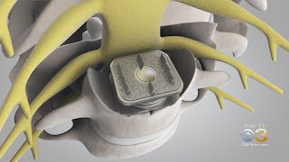 High-Tech Help For People With Weakening Spines