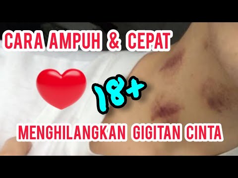 Cara Tercepat & Ampuh Menghilangkan Bekas Cupang Di leher