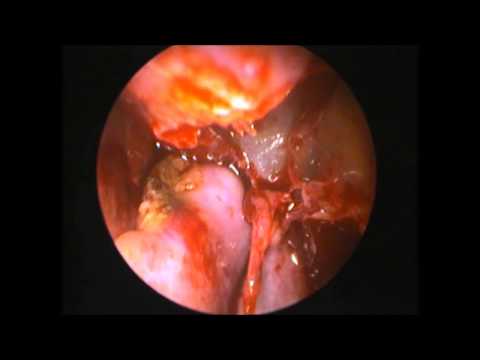 Nasal Polyp Removal Surgery. 