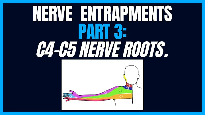 Nerve Entrapments Part 3: C4-C5 Nerve Roots.