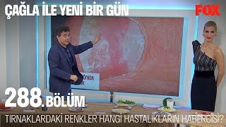 Tırnaklardaki Renkler Hangi Hastalıkların Habercisi... Çağla Ile Yeni Bir Gün 288. Bölüm