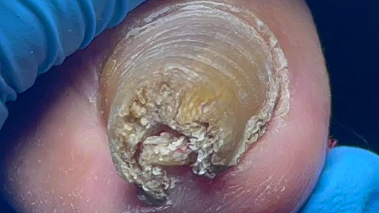 Очень редкая, супербольшая, кудрявая броня! Вытащите супербольшие ногти【Мастер педикюра Линь Цзюнь】