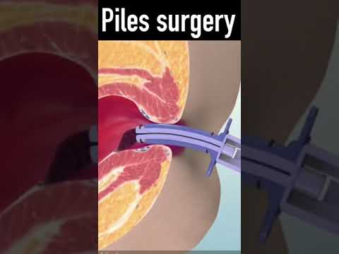 3d animation of Piles rubber band surgery #shorts