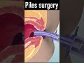 3d animation of Piles rubber band surgery #shorts