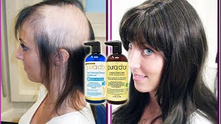 HAIR LOSS SUFFERER TESTS PURA D'OR PROFESSIONAL BIOTIN SHAMPOO 8 WEEK  REVIEW WITH BEFORE AND AFTER 