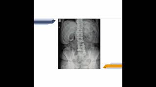 Calcificación abdominal