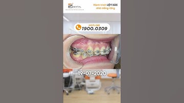 Hành trình LỘT XÁC nhờ niềng răng của Hoài Phương