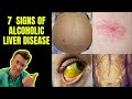 Doctor outlines 7 signs of alcoholic liver disease ascites caput medusae jaundice  more