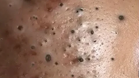 Most Satisfying Blackhead Removal ~ Enjoy Your Day...