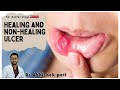 Healing and non healing ulcer       