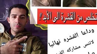 تخلص من القشرة نهائيا علاج قشره الشعر قشرة_الشعر القشرة  طبعا سيبلك هديه اول تعليق