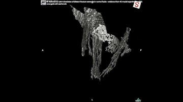 Studying open fractures in CT-scanner - Percolating fracture network