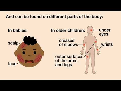 Видео: Хүүхдэд экземийг хэрхэн эмчлэх вэ: 15 алхам (зурагтай)