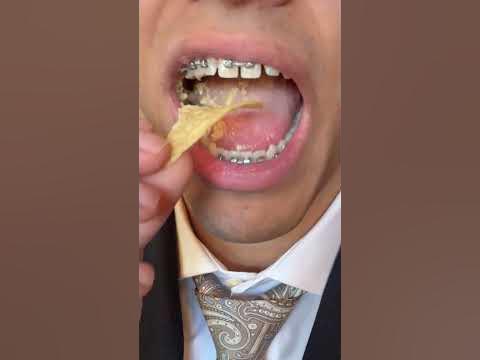 chips vs. braces - YouTube