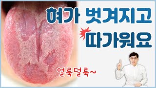 양성 이동성 설염/지도혀/혀가 벗겨지고 따가워요