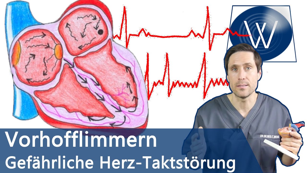 Vorhofflimmern: Wenn Ihr Herz den Takt verliert! Ursachen, Therapie & lebensgefährliche Folgen ...
