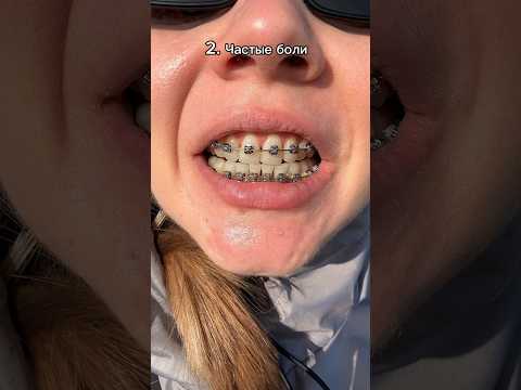 У брекетов есть минусы. Мои впечатления