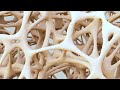 Osteoporosis Explained