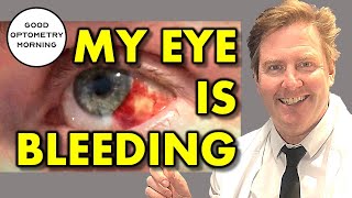 HOW TO TREAT BROKEN BLOOD VESSEL IN EYE: what does it mean & how to treat bleeding or bloodshot eye