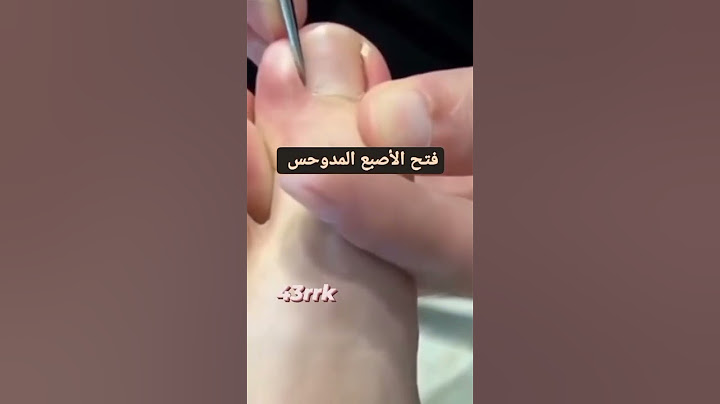 فتح الأصبع المدوحس 🥺✅