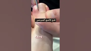 فتح الأصبع المدوحس 