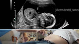 17 weeks active fetus | Ultrasound Case