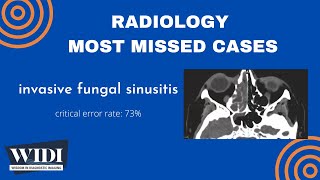 Most Missed Cases: Invasive Fungal Sinusitis