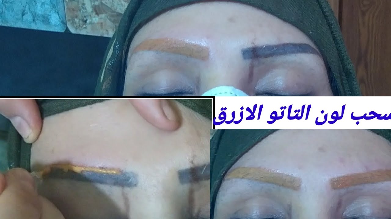 Удаление татуировок и лечение синего, черного и других нежелательных цветов; легкое превращение и...