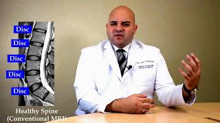 Dino Samartzis - The Ute Disc Sign On Mri And Its Clinical Relevance