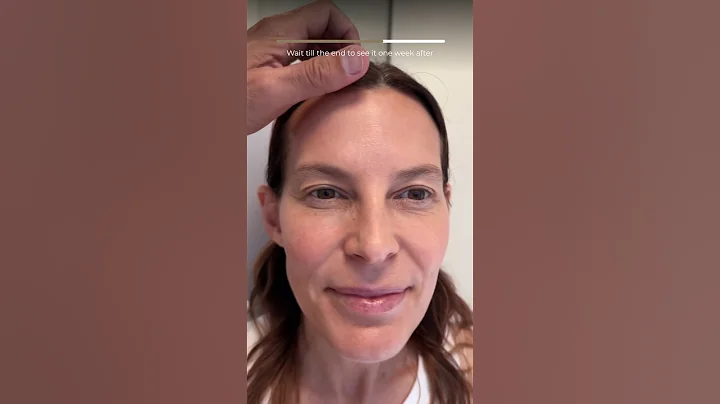 7 days update from endoscopic browlift and upper blepharoplasty