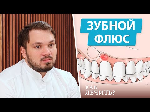 Флюс - симптомы и стадии лечения (периостит зуба)