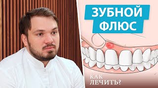 Флюс - симптомы и стадии лечения (периостит зуба)