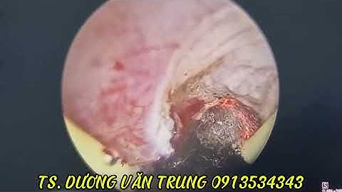 CẮT U TUYẾN TIỀN LIỆT NỘI SOI- ÔNG NGỌC- TS.BS DƯƠNG VĂN TRUNG 0913534343