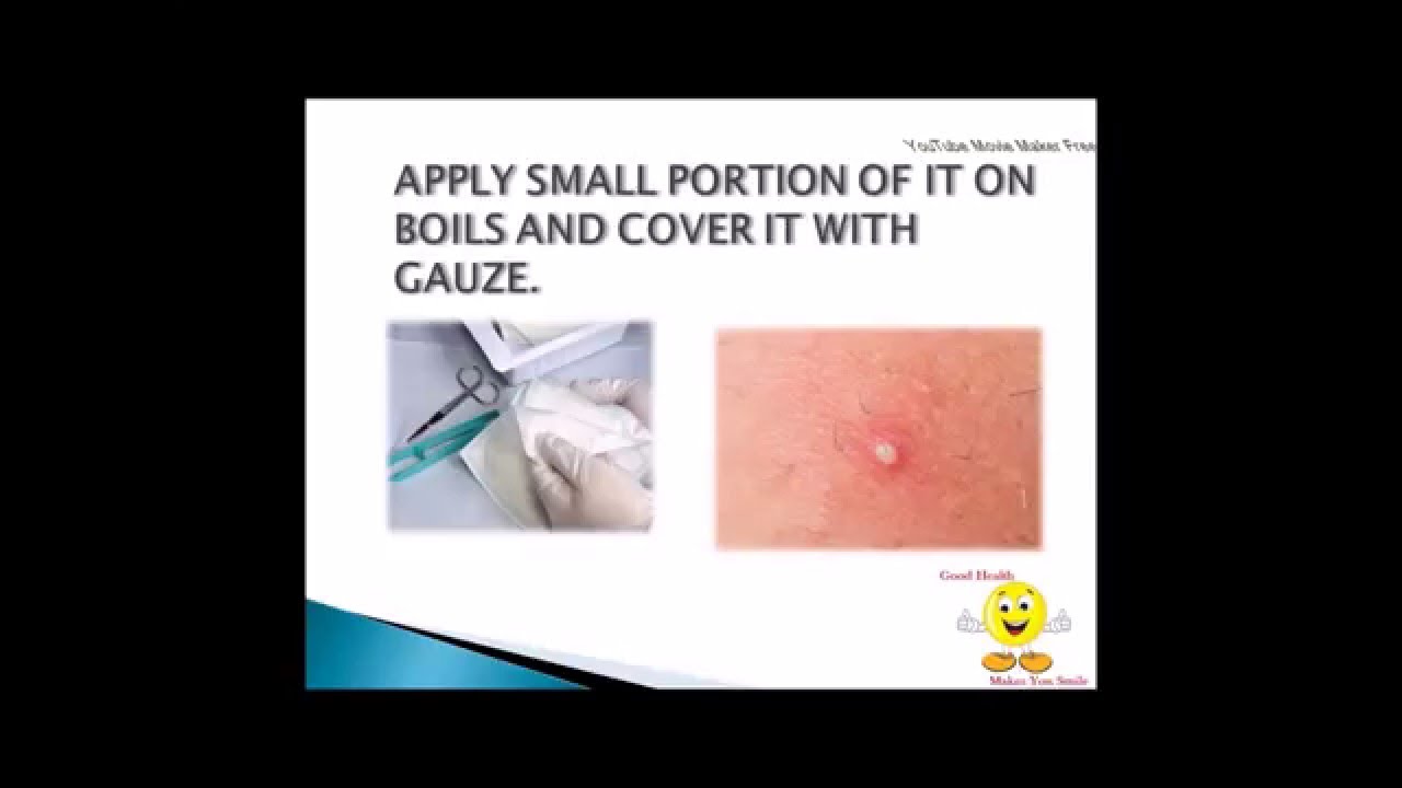 how to get rid of boil naturally YouTube