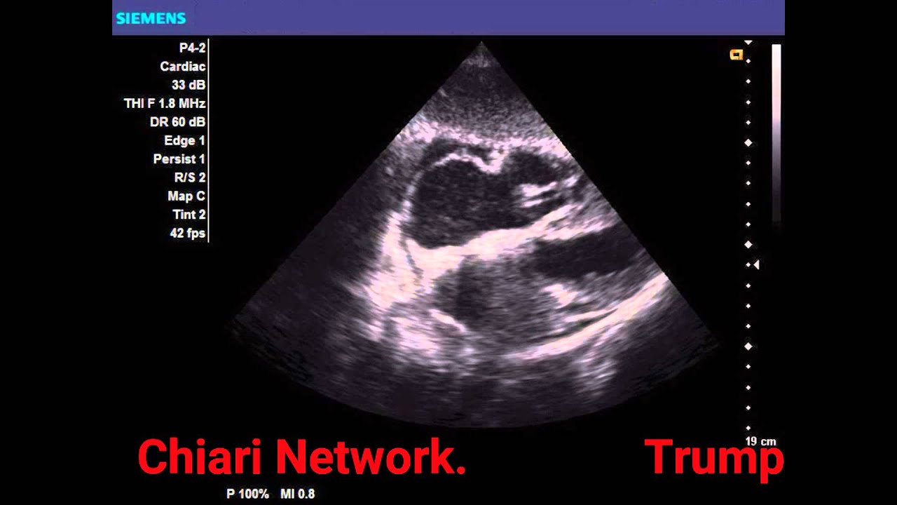Chiari Network YouTube chiari-network-youtube