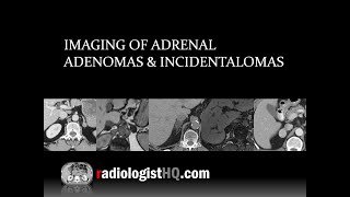 Imaging of Adrenal Adenomas & Incidentalomas