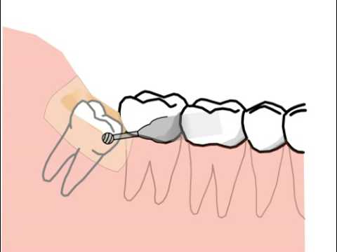 Trickfilm Uber Die Entfernung Von Unteren Weisheitszahnen Youtube
