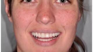 Hybridge Dental Implants   Full Mouth Process