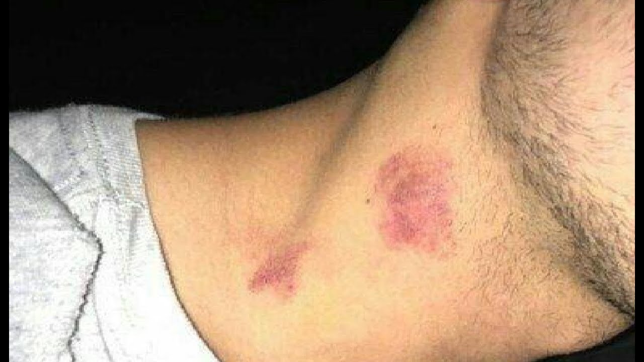 how to properly remove a hickey in minutes - best way to get rid of a